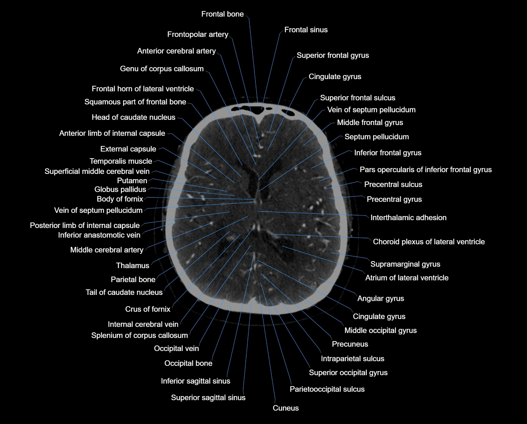 CT scan brain axial labelled cross sectional anatomy image-img-000038.webp